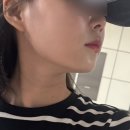 손가정의학과 | 대구 신세계가정의학과 편평사마귀 제거 후기-2