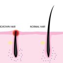 How to prevent ingrown hairs 이미지