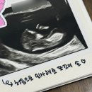 강남-168 | 목투명대 두꺼움 압구정함춘 융모막검사 후기