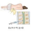 박테리아성 뇌수막염[Bacterial meningitis]감염성 질환, 뇌신경정신질환 이미지