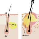 대전염증주사 맞고 피부 꺼졌다는 후기, 사실인가요?