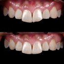 이랑치과기공소 | 앞니가 깨졌어요 / 깨진 앞니를 간단히 치료하는 레진 치료 / 앞니 레진 후기