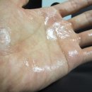 남성반점 이미지