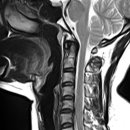 경추 mri ㅡ 상부흉추 포함 판독 부탁드립니다 이미지