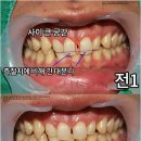 채움치과기공소 네이버블로그