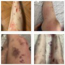 권비뇨기과의원 | 코로나 백신 후유증 : 자율신경실조증/섬유근육통 치료 후기-구미 오케이마취통증의학과