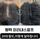 미리내 | 20대 남성 탈모관리 효과! 미리내스칼프 실제 후기 공개