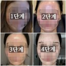 코미인의원 | 강남 세르프 리프팅 이중턱 4단 변신 (리오셀의원)