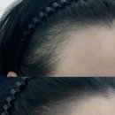 비비헤어라인 | 인천 부평눈썹 잘하는 곳 비비브로우 헤어라인 후기 여자 M자 탈모 정수리 고민
