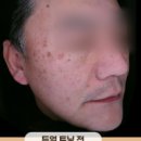 톱스타성형외과의원 | 광주잡티제거, 2가지 모르면 10번해도 또 생깁니다!