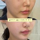 곰부스터 | 강남피부과 올리디아 120 콜라겐 스킨부스터 주사 효과 후기