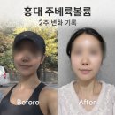 운동하는의원 | 홍대 쥬베룩볼륨 솔직 후기｜운동하는 사람이 느낀 자연스러운 변화