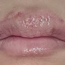 강남샘약국 | 포다이스반 시술받았다. 일주일 후기