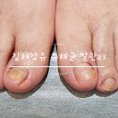 김해장유 유해균 발톱관리 꾸준함으로 달라진 발톱변화