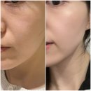 피부도로공사 파메스틱 코나피딜 세멘시트 사용방법 부작용 후기