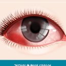 한쪽 눈충혈 원인, 결막하출혈 증상 (눈에핏줄, 눈실핏줄터짐) 이미지