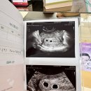 디온약국 | 쌍둥이 아기집 심장소리 임신 초기 증상 갑상선 TSH 수치 (동탄 디온/위대한 탄생)