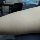 케어114 | 수원 튼살커버 관리 후기, 더광교스칼프스킨케어에서 자신감 되찾았어요