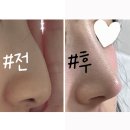 충경의원 | 매부리코성형 후 삶의 질이 달라짐♥ (코성형 비용)