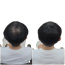 주식회사신재 | [공지] 부산 가발 샴푸 가능한 정수리 커버!!두피가 건강해야 탈모가 개선됩니다