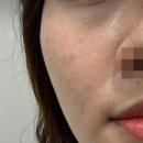 더리즌 | 바이리즌 효과 목주름 < 팔자 후기 부작용 솔직비교 사진有