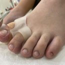 레푸스인하대역점 내성발톱 무좀발톱 발각질 문제성발 | 레푸스 인하대역점 내성발톱 무좀발톱 발각질 문제성발 방문후기입니다