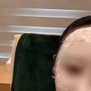 크림의원 | 영등포 #사려니의원 편평사마귀 제거 후기 / 예약 팁 재생크림 추천