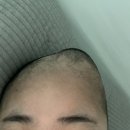 주래 | 뇌종양 일기5(악성뇌종양 성상세포종 3등급 방사선 후기)