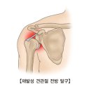 재발성 견관절 전방 탈구[Recurrent Anterior Glenohumeral Dislocation] 이미지