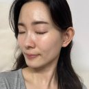 이수역 | 이수역 피부과 티타늄리프팅 후기 효과, 통증