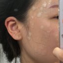 세운한의원 | 신림피부과 추천 편평사마귀 완전 아무는 과정 및 결과까지 후기