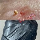 헤어캐슬로즈마리 | 비립종압출 잘하는 잠실피부관리 달리아에스테틱 비립종관리 후기