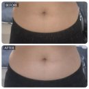 제일편안의원 | 청담피부과의원 바디 온다리프팅 리니어지 복부 6만줄 리얼 후기 (일주일 변화)