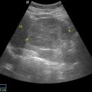 Huge hepatic hemangioma at LL of Liver (48/F) 이미지