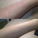 아토피 피부염 증상에 도움 된 아토피 보습제 추천해요