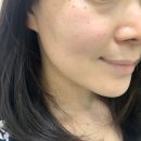 티엘엠 | [내돈내치료] 20만원으로 주근깨, 기미 잡티 한방에 다 없앴어요♥ (완전 유명한 예수의원)