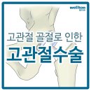 고관절골절 치료는 인공관절수술이 효과적! 이미지