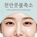 좋아 | 천안콧볼축소 보톡스로 좋아진 후기(시술자 입장)
