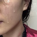 인진약국 | 여름 피부 뒤집어졌을때 약국 모낭염 연고 + 기초 관리 tip