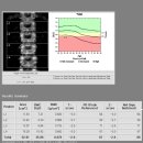 고려엔도홍내과의원 | 극난저 30대 골다공증 치료 상담 후기(1)