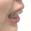 화인치과병원 | <창원 화인치과> 클리피씨 교정 후기