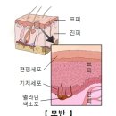 모반(Nevus)피부질환이란? 이미지