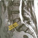 전방전위증(Spondylolisthesis) 이미지