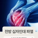 십자의원 | 경산 정형외과 전방 십자인대 파열, 수술이 꼭 필요할까?