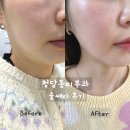 청담동 | 청담동피부과 울쎄라 내돈내산 후기