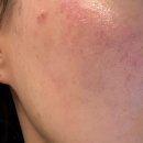 원레이져 | [서울 노원] 루나크의원 달빛샤워 레이저 토닝 3회차 효과 솔직후기 내돈내산