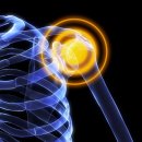 중앙탑정형외과의원 | 신대방정형외과 어깨 통증 오십견 도수치료로 해결 가능할까