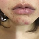 올킬몰 | (사진후기) 턱피지 관리 다 실패 후 하얀 턱 여드름 원인 올킬