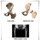 슬관절염(무릎관절염) 증상 이미지