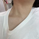 환스킨케어 | 대구 편평사마귀 제거 - 민간요법 실패 후 페이즈스킨케어 고주파치료 받은 후기 (얼굴,목,가슴)